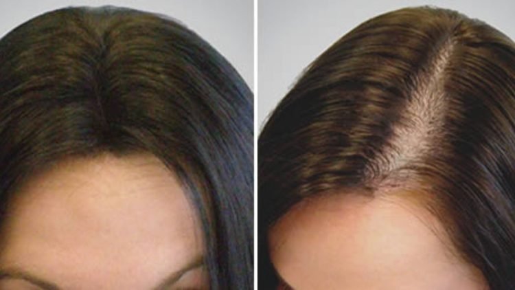 comment accelerer la repousse des cheveux naturellement 750x422 1